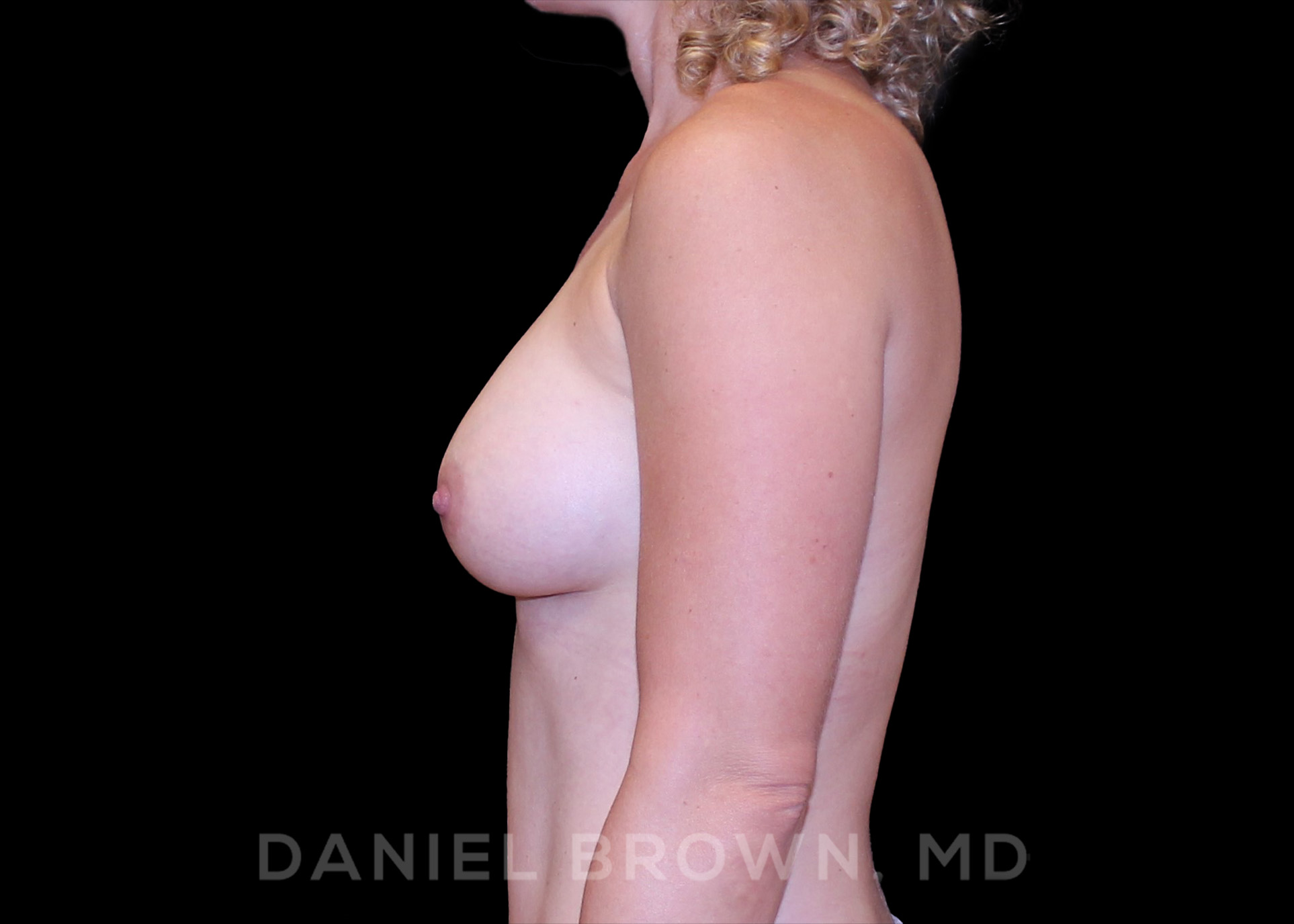 Breast Augmentation Patient Photo - Case 2478 - after view-3