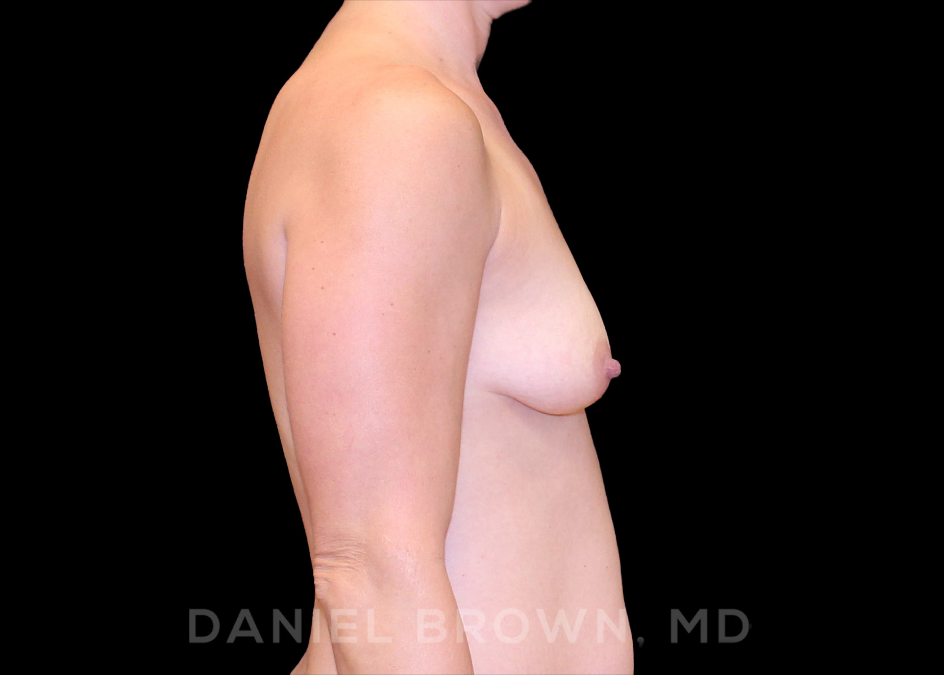 Breast Augmentation Patient Photo - Case 2478 - before view-4