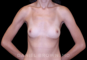Breast Augmentation - Case 2489 - After