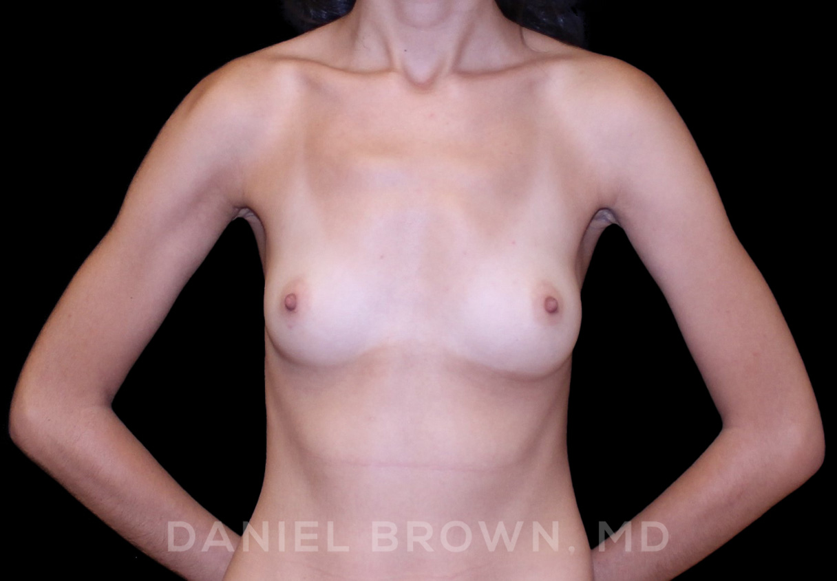 Breast Augmentation Patient Photo - Case 2489 - before view-0