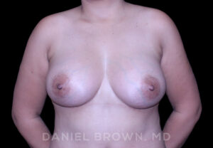 Breast Augmentation - Case 2500 - After