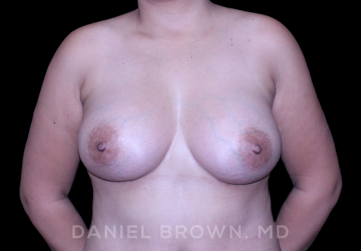 Breast Augmentation Patient Photo - Case 2500 - after view