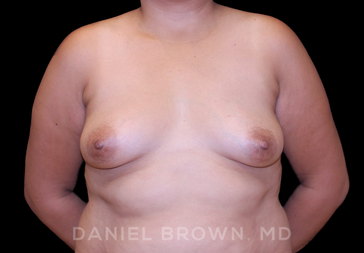 Breast Augmentation Patient Photo - Case 2500 - before view-