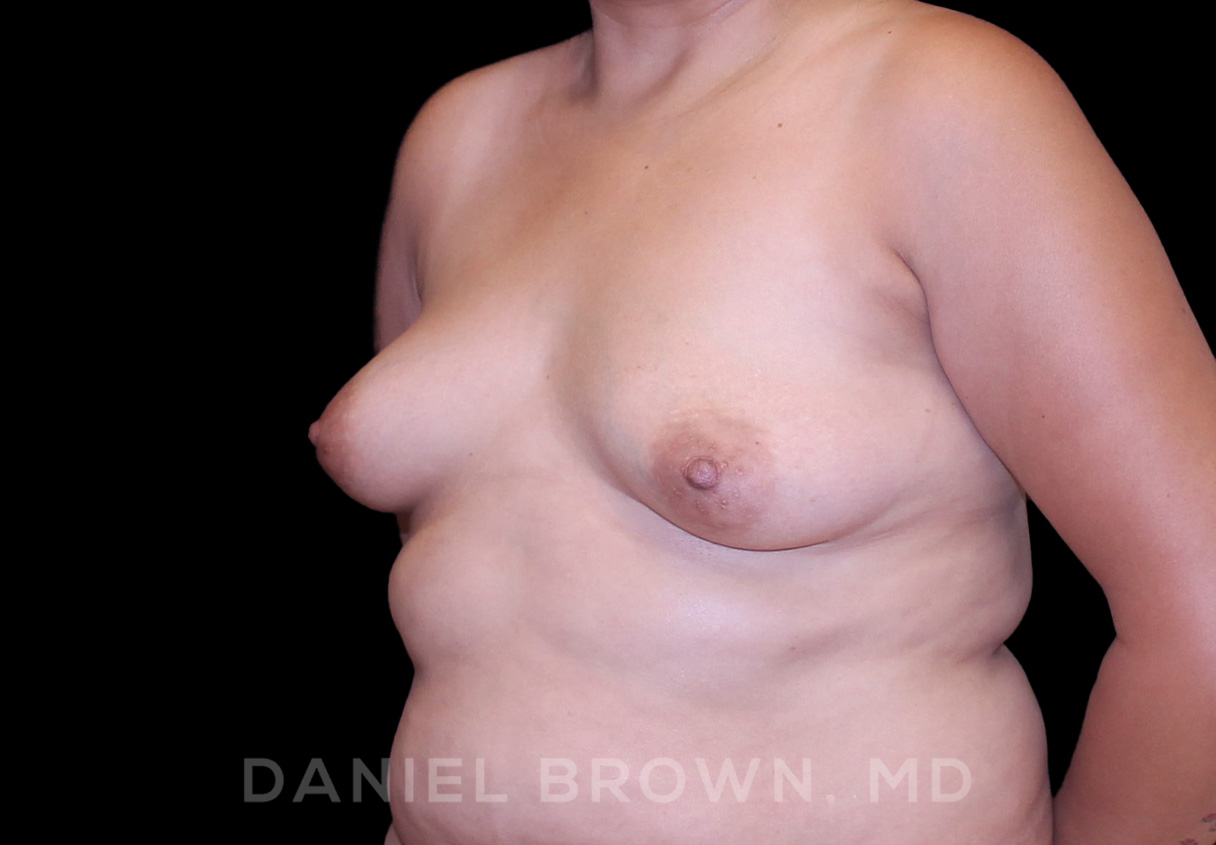 Breast Augmentation Patient Photo - Case 2500 - before view-