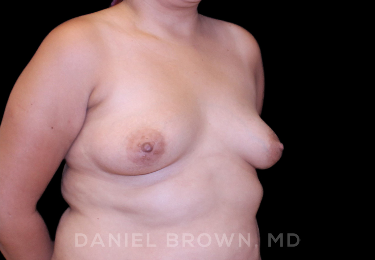 Breast Augmentation Patient Photo - Case 2500 - before view-2