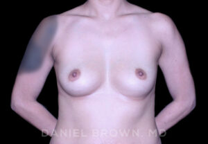 Breast Augmentation - Case 2522 - Before