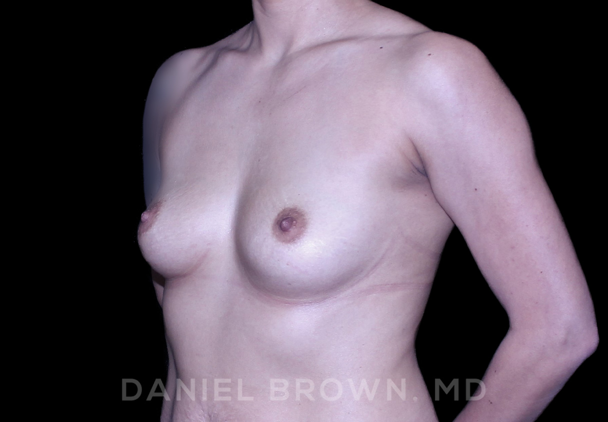 Breast Augmentation Patient Photo - Case 2522 - before view-