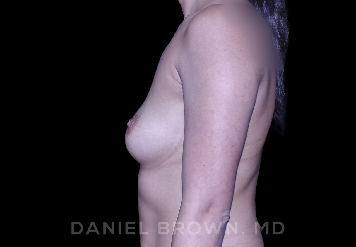 Breast Augmentation Patient Photo - Case 2522 - before view-