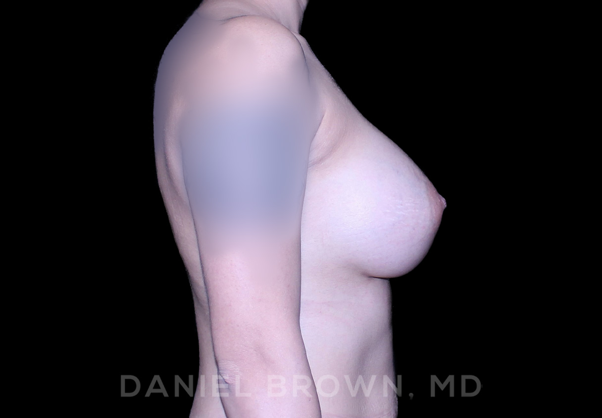 Breast Augmentation Patient Photo - Case 2522 - after view-4