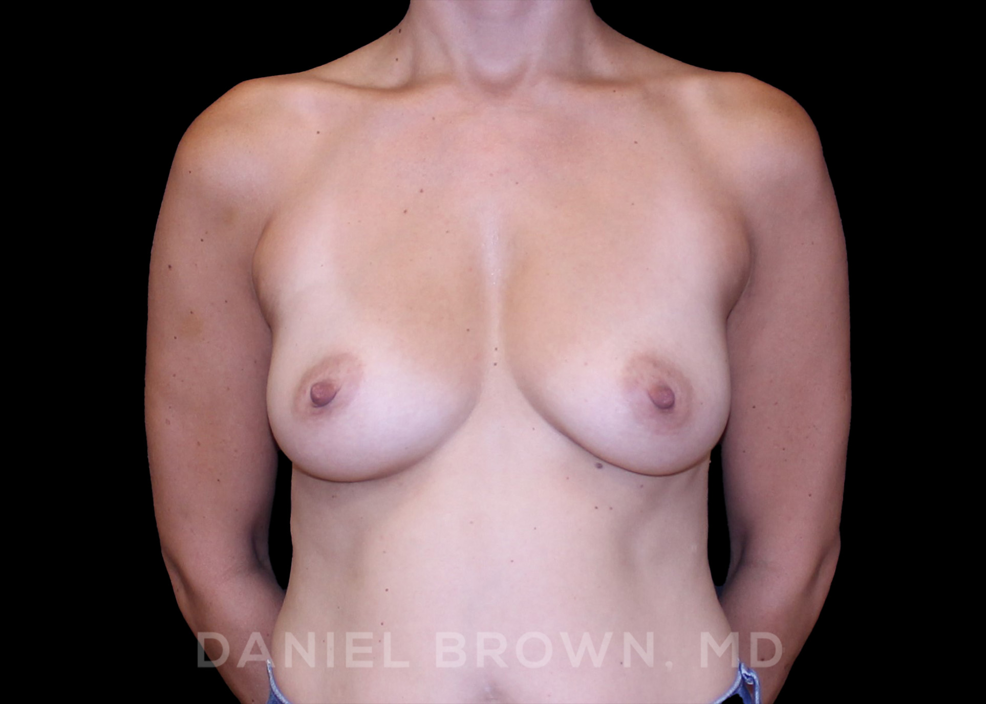 Breast Augmentation Patient Photo - Case 2533 - before view-
