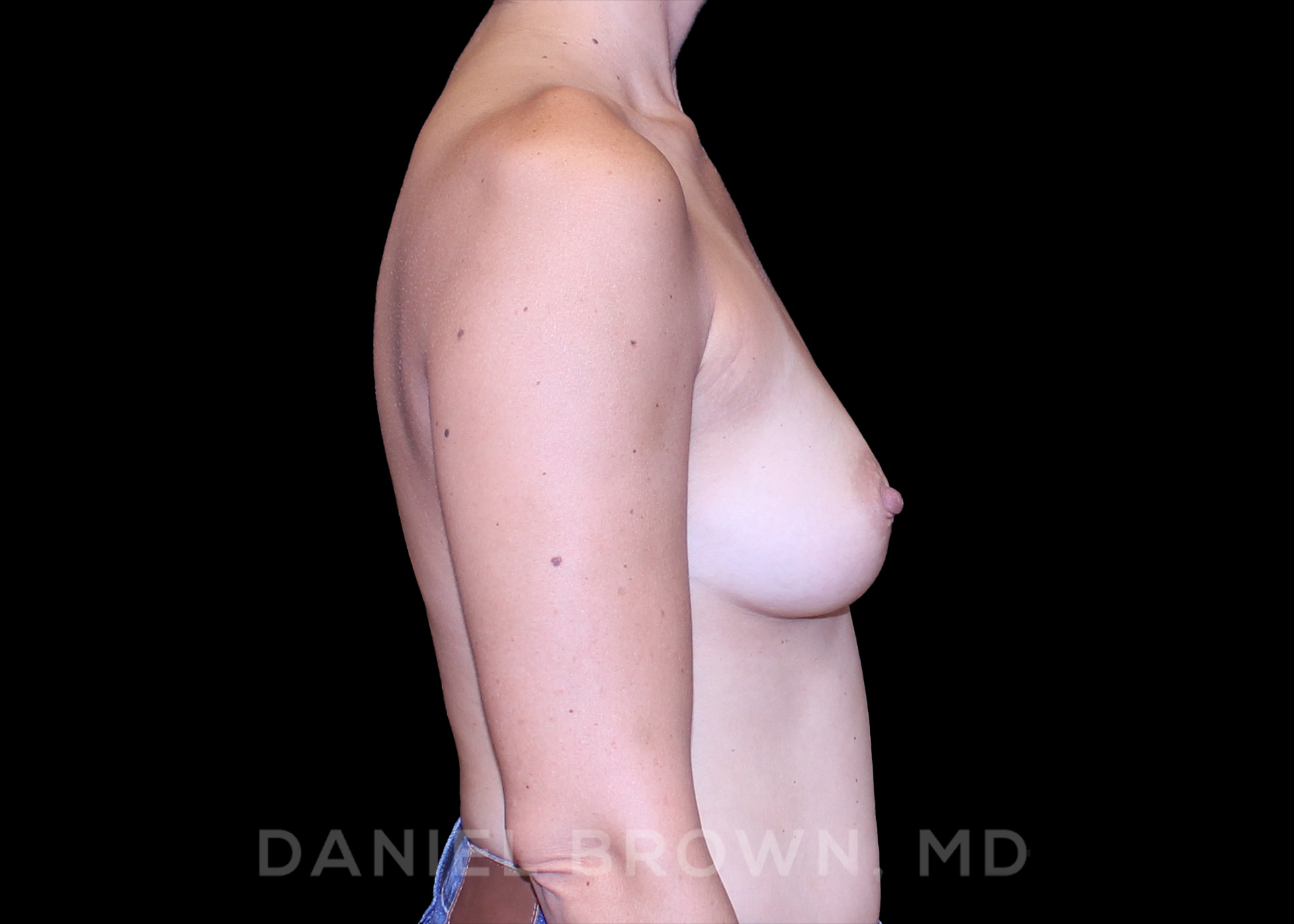 Breast Augmentation Patient Photo - Case 2533 - before view-