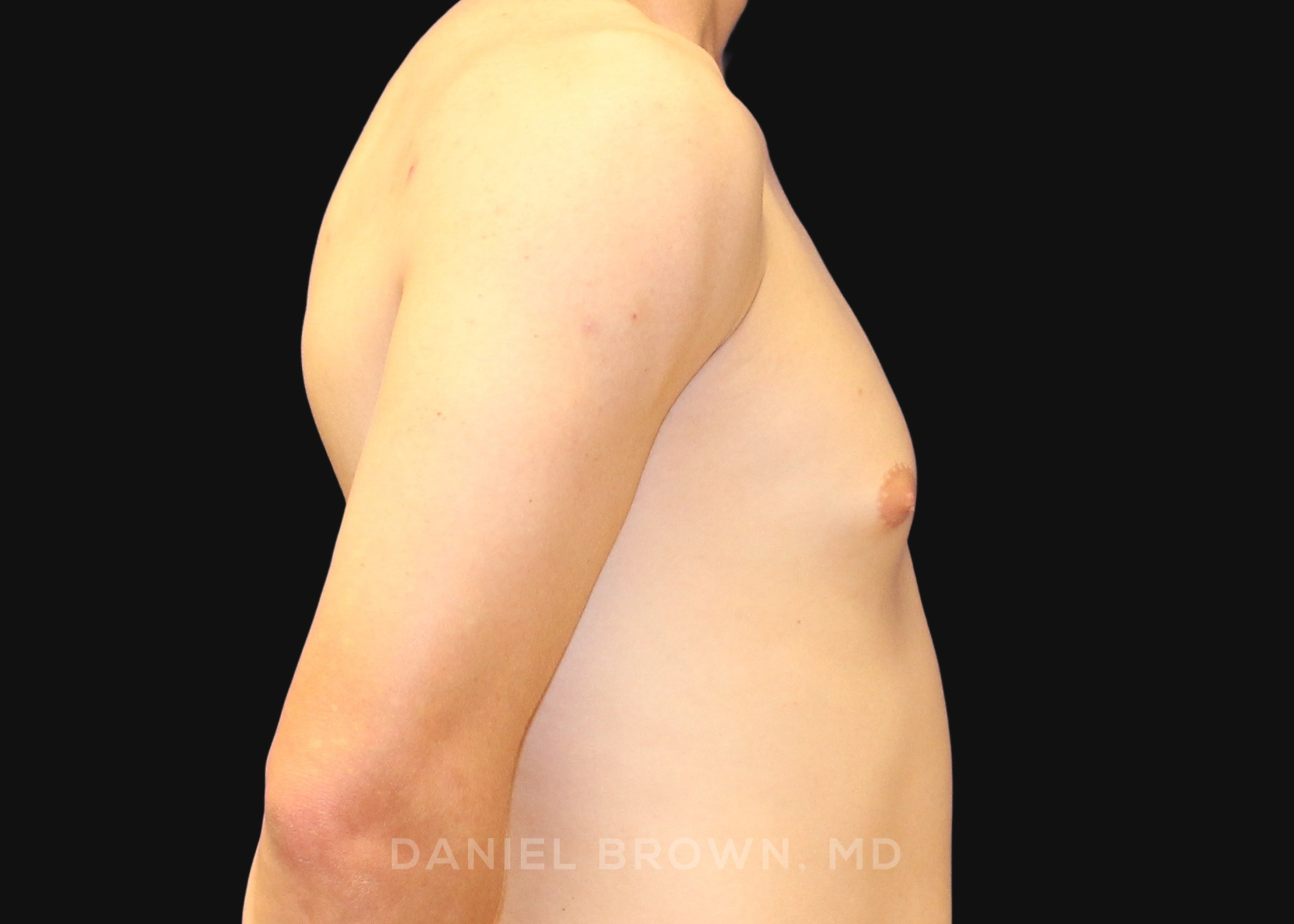 Male Breast Reduction Patient Photo - Case 2544 - before view-4