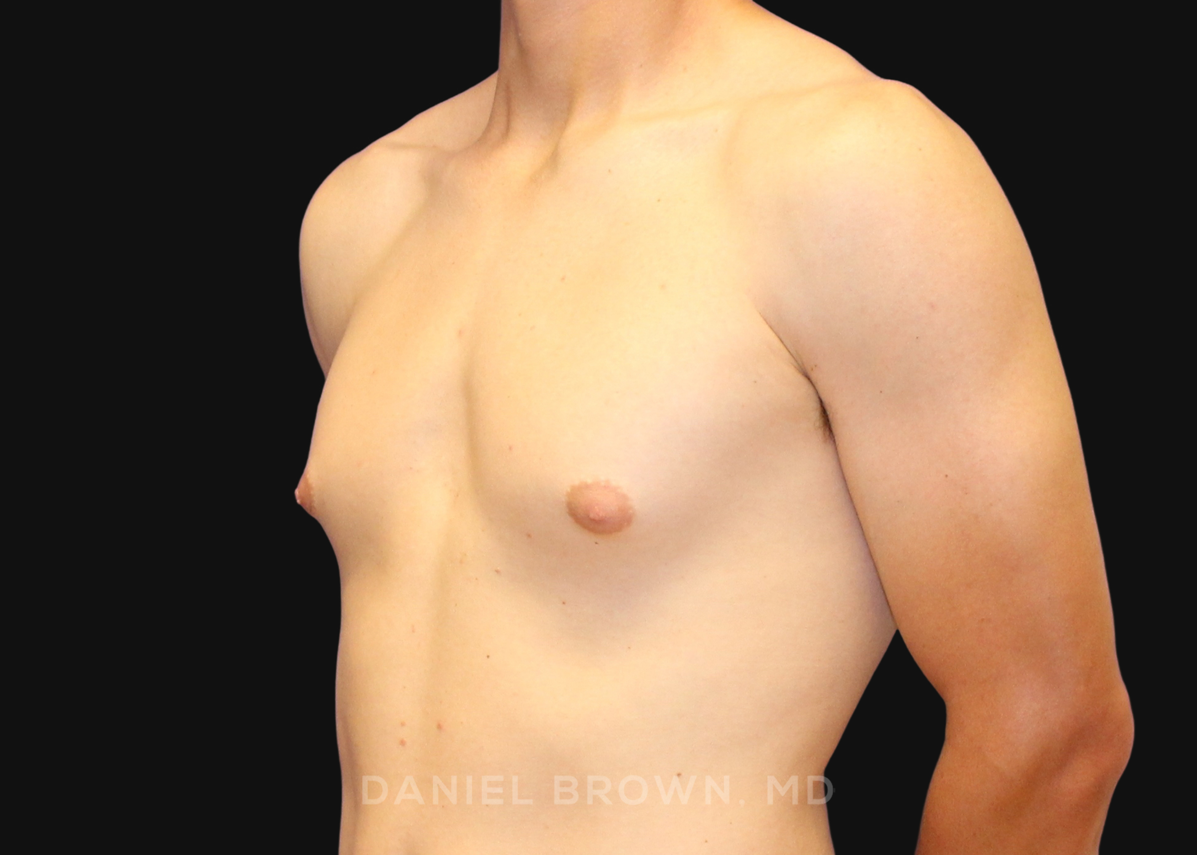 Male Breast Reduction Patient Photo - Case 2544 - before view-1