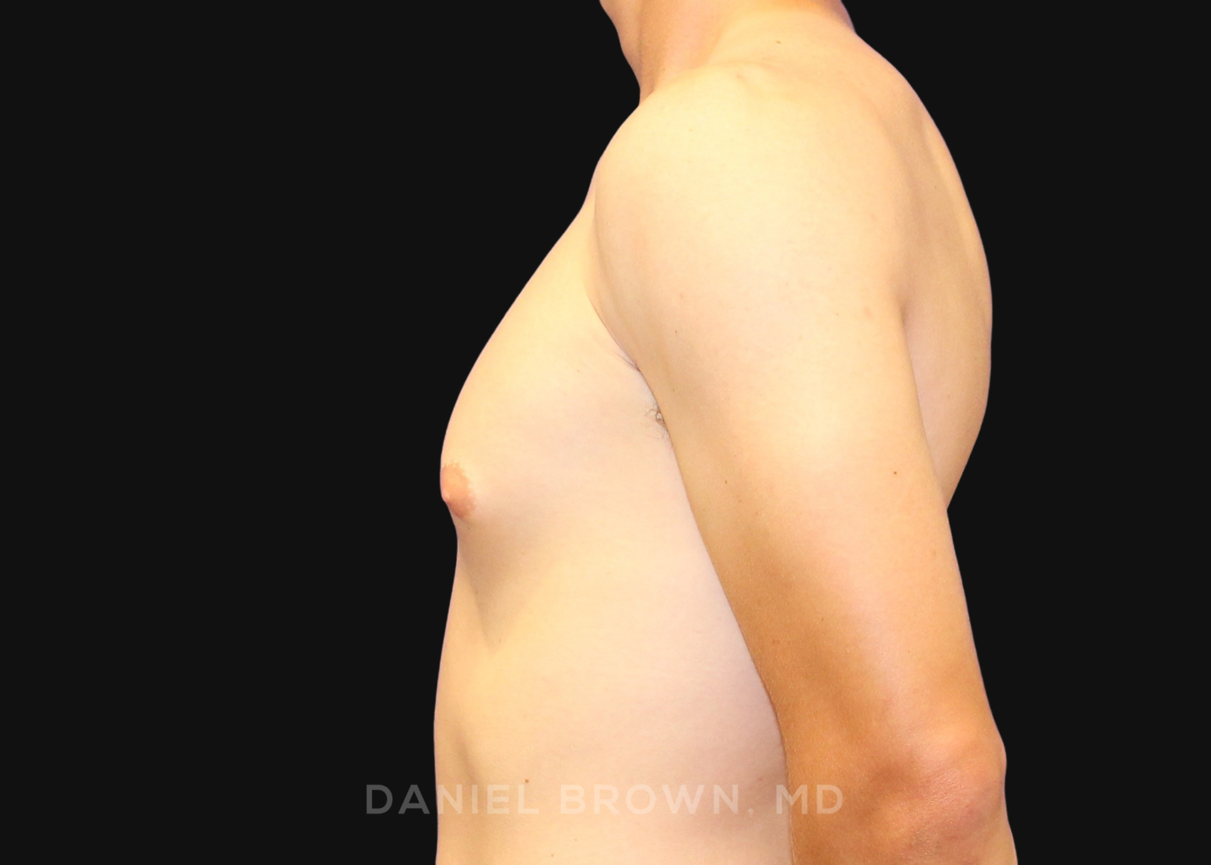 Male Breast Reduction Patient Photo - Case 2544 - before view-3