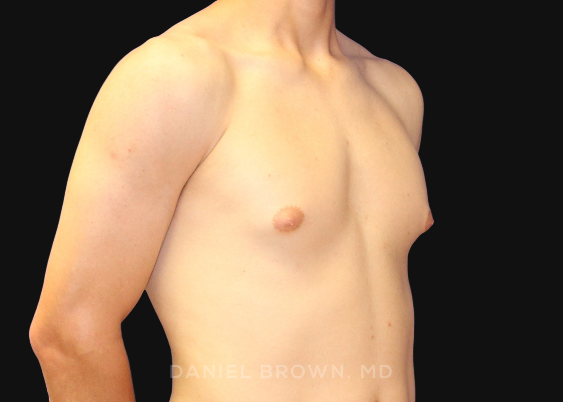 Male Breast Reduction Patient Photo - Case 2544 - before view-