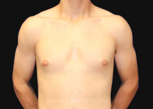 Male Breast Reduction - Case 2544 - Before