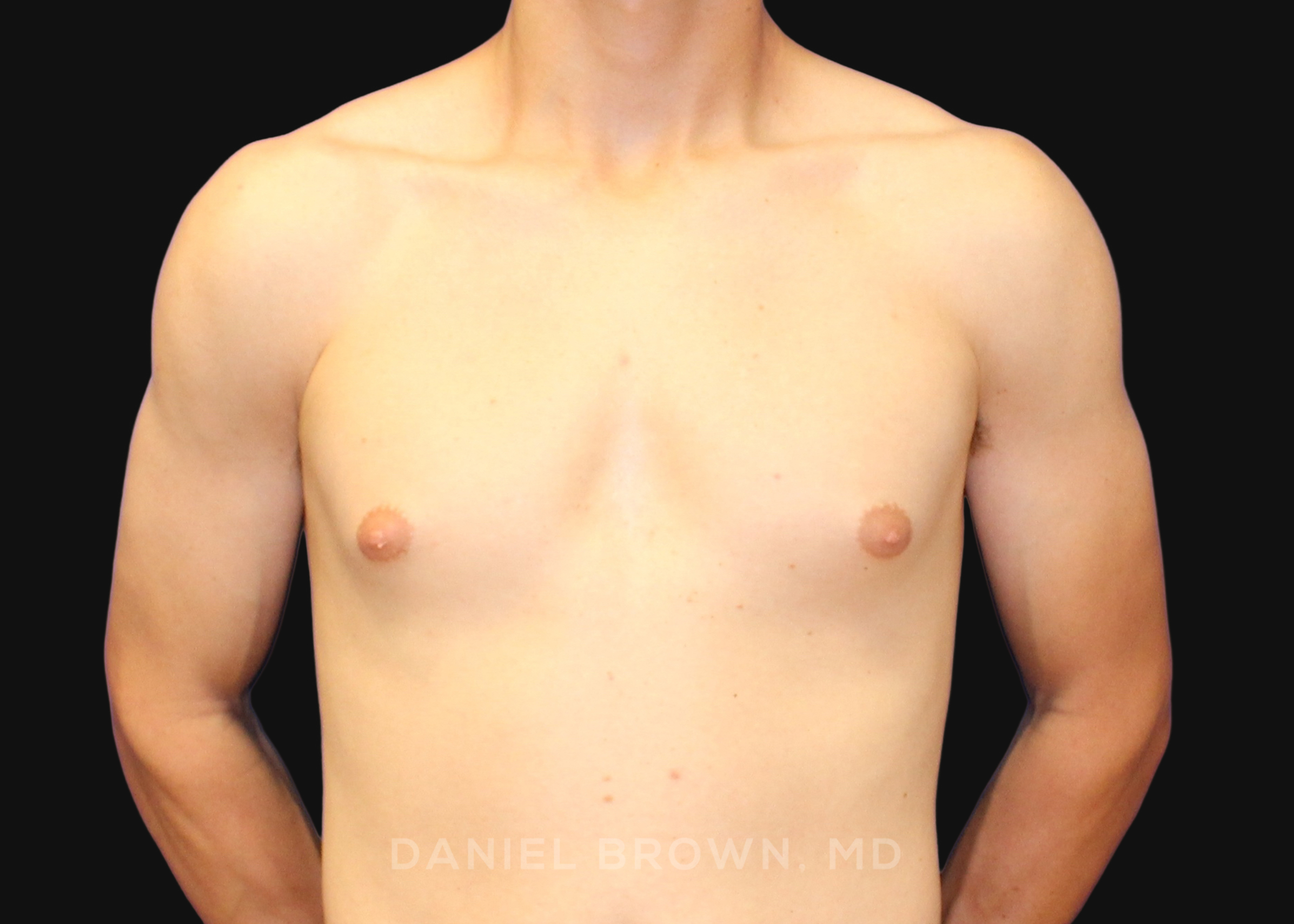 Male Breast Reduction Patient Photo - Case 2544 - before view-0