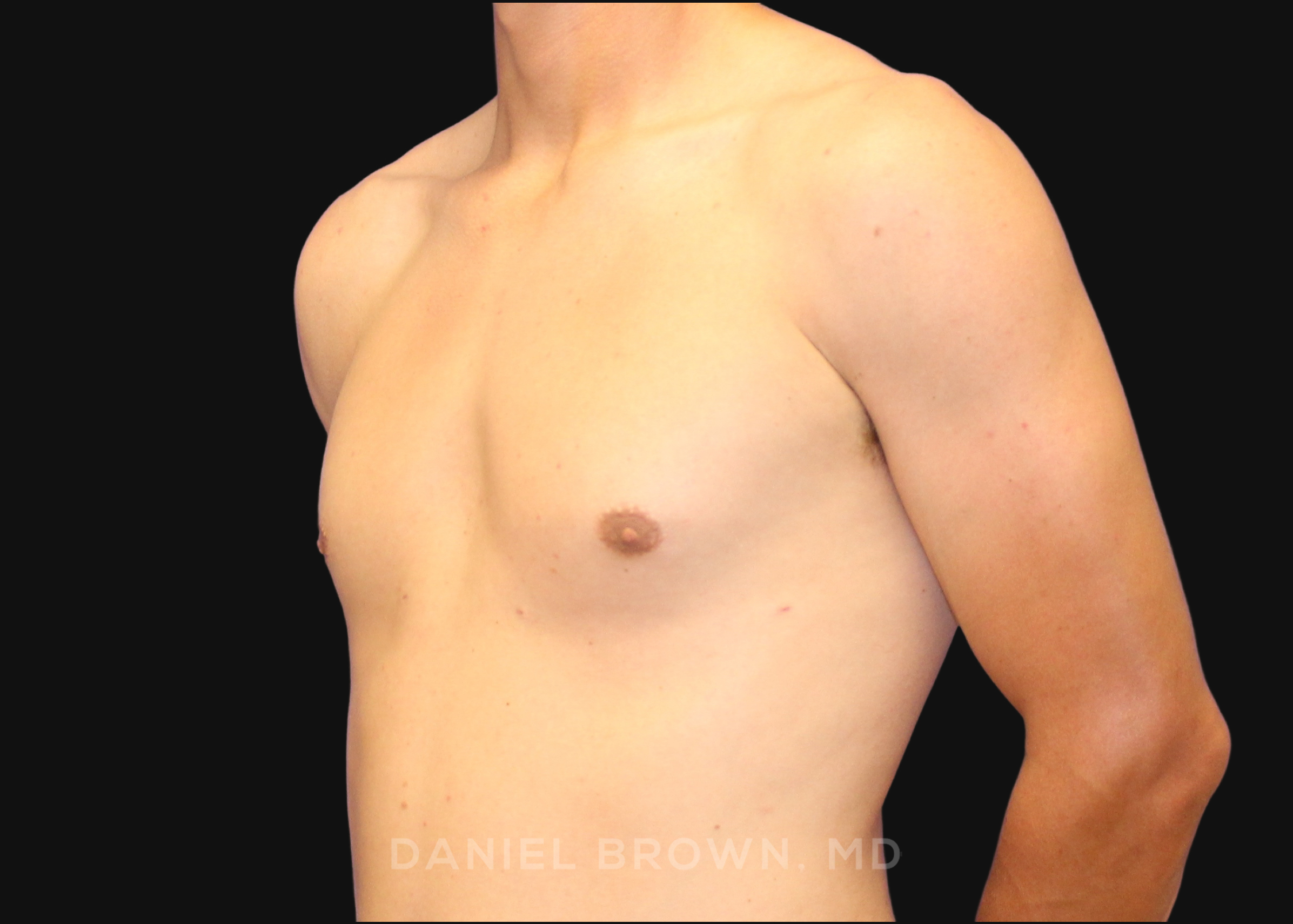 Male Breast Reduction Patient Photo - Case 2544 - after view-1