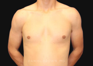 Male Breast Reduction - Case 2544 - After