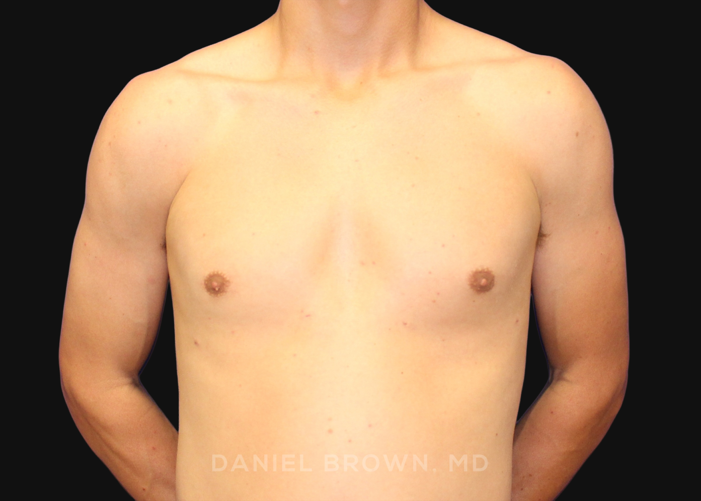 Male Breast Reduction Patient Photo - Case 2544 - after view