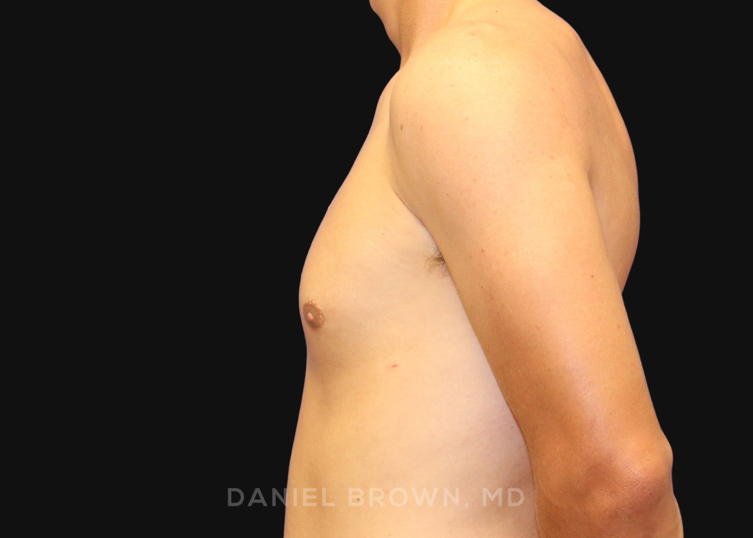 Male Breast Reduction Patient Photo - Case 2544 - after view-3