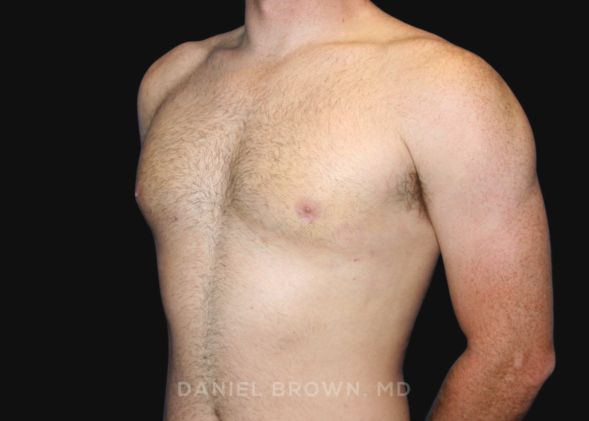 Male Breast Reduction Patient Photo - Case 2555 - after view-1