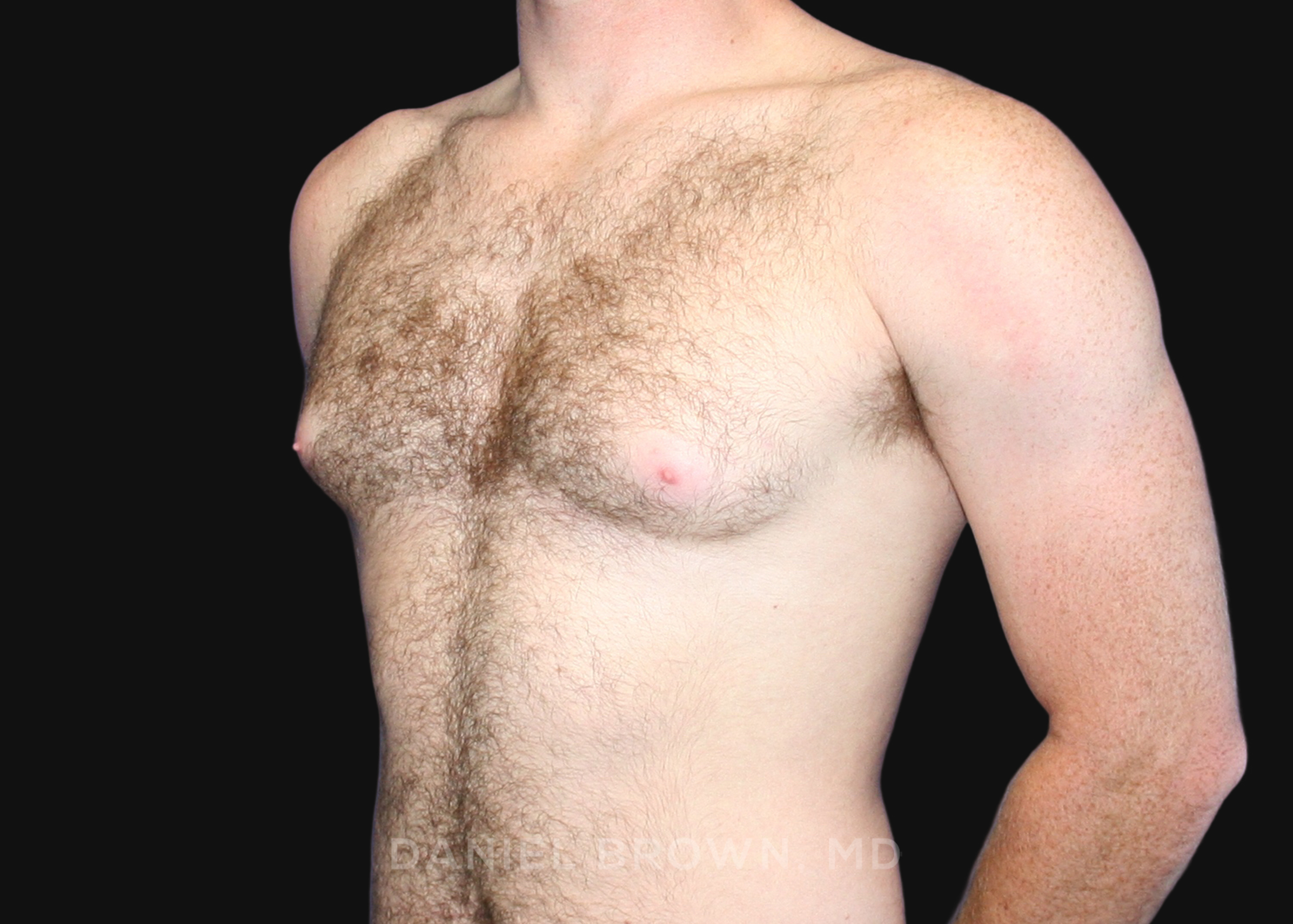 Male Breast Reduction Patient Photo - Case 2555 - before view-1