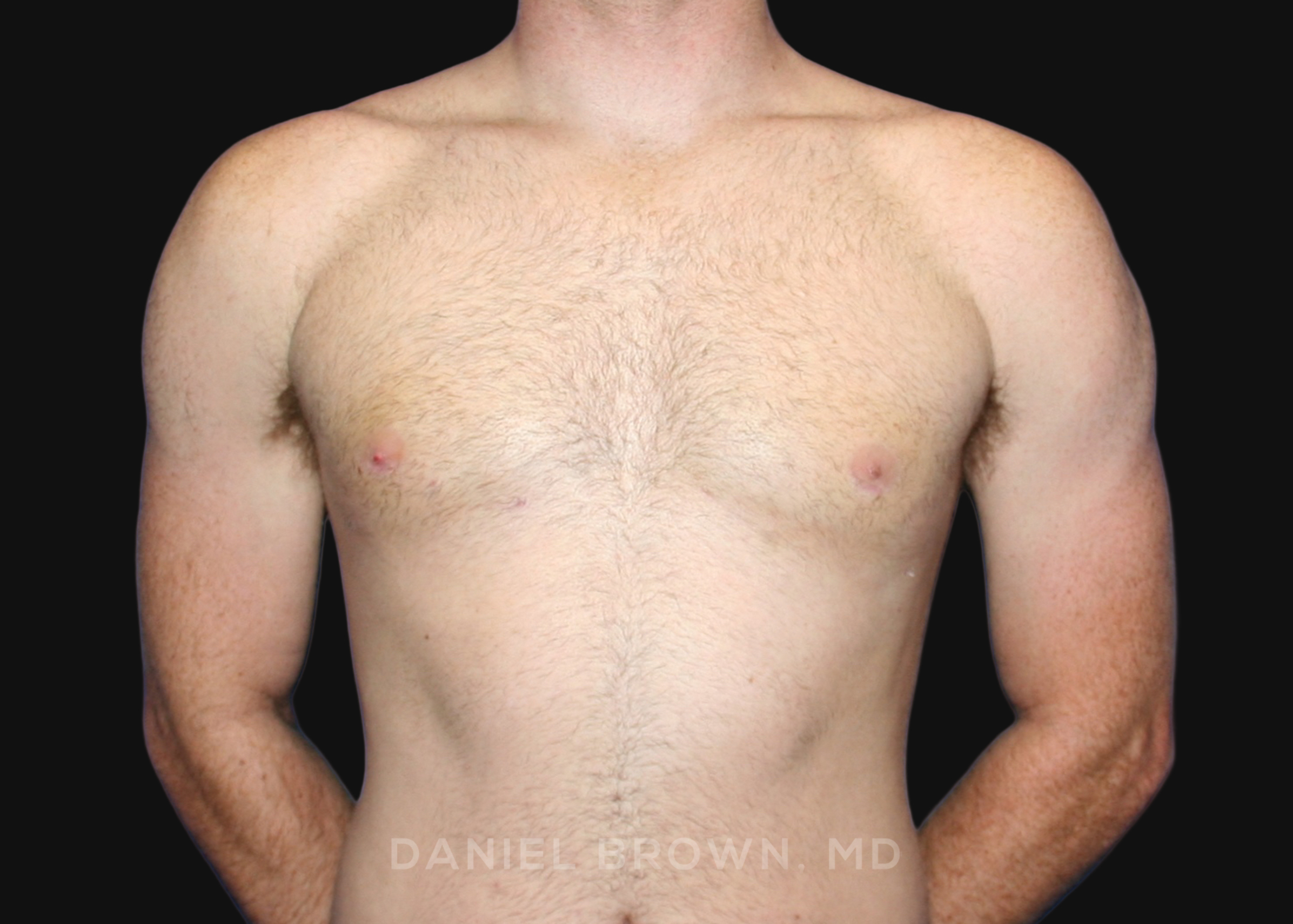 Male Breast Reduction Patient Photo - Case 2555 - after view-0