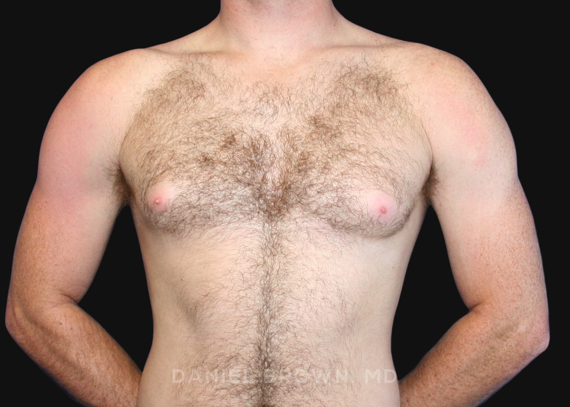 Male Breast Reduction Patient Photo - Case 2555 - before view-0