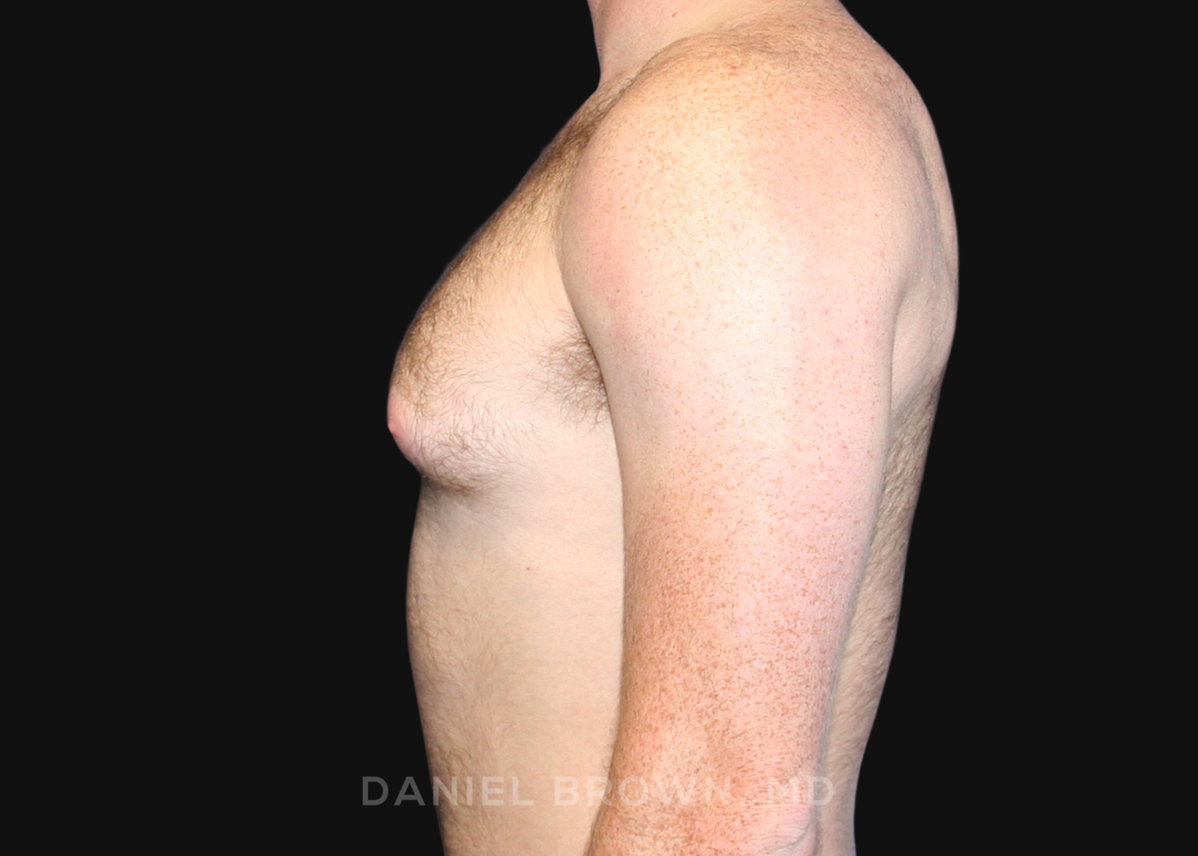 Male Breast Reduction Patient Photo - Case 2555 - before view-2