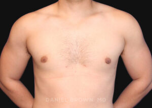 Male Breast Reduction - Case 2562 - After