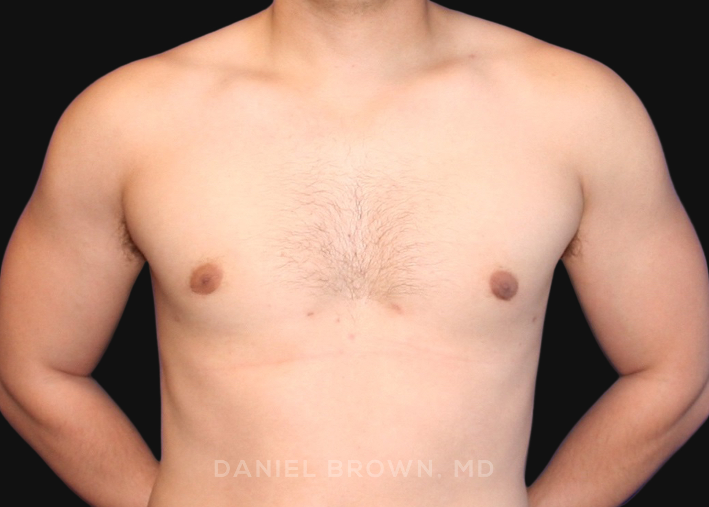 Male Breast Reduction Patient Photo - Case 2562 - after view