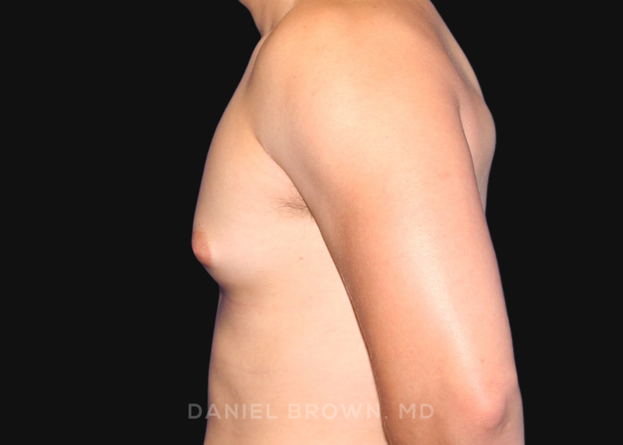 Male Breast Reduction Patient Photo - Case 2562 - before view-