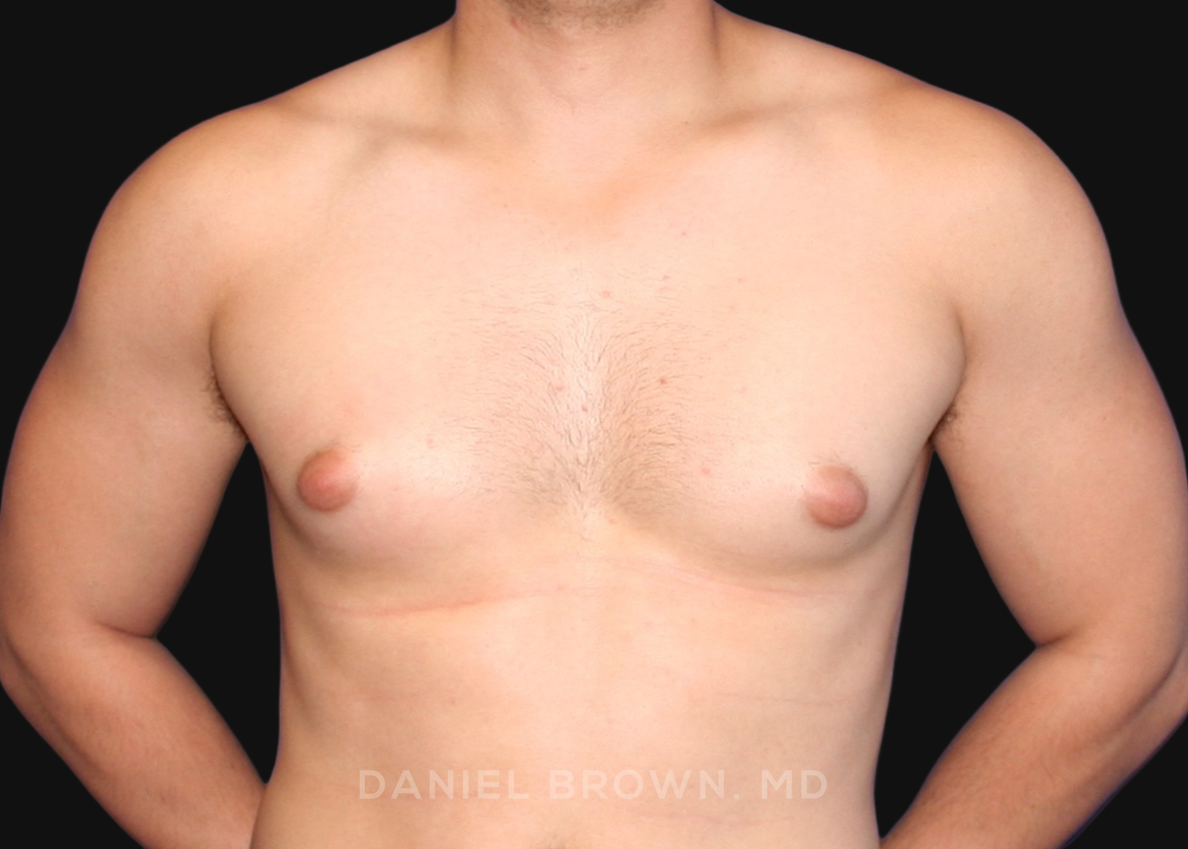 Male Breast Reduction Patient Photo - Case 2562 - before view-
