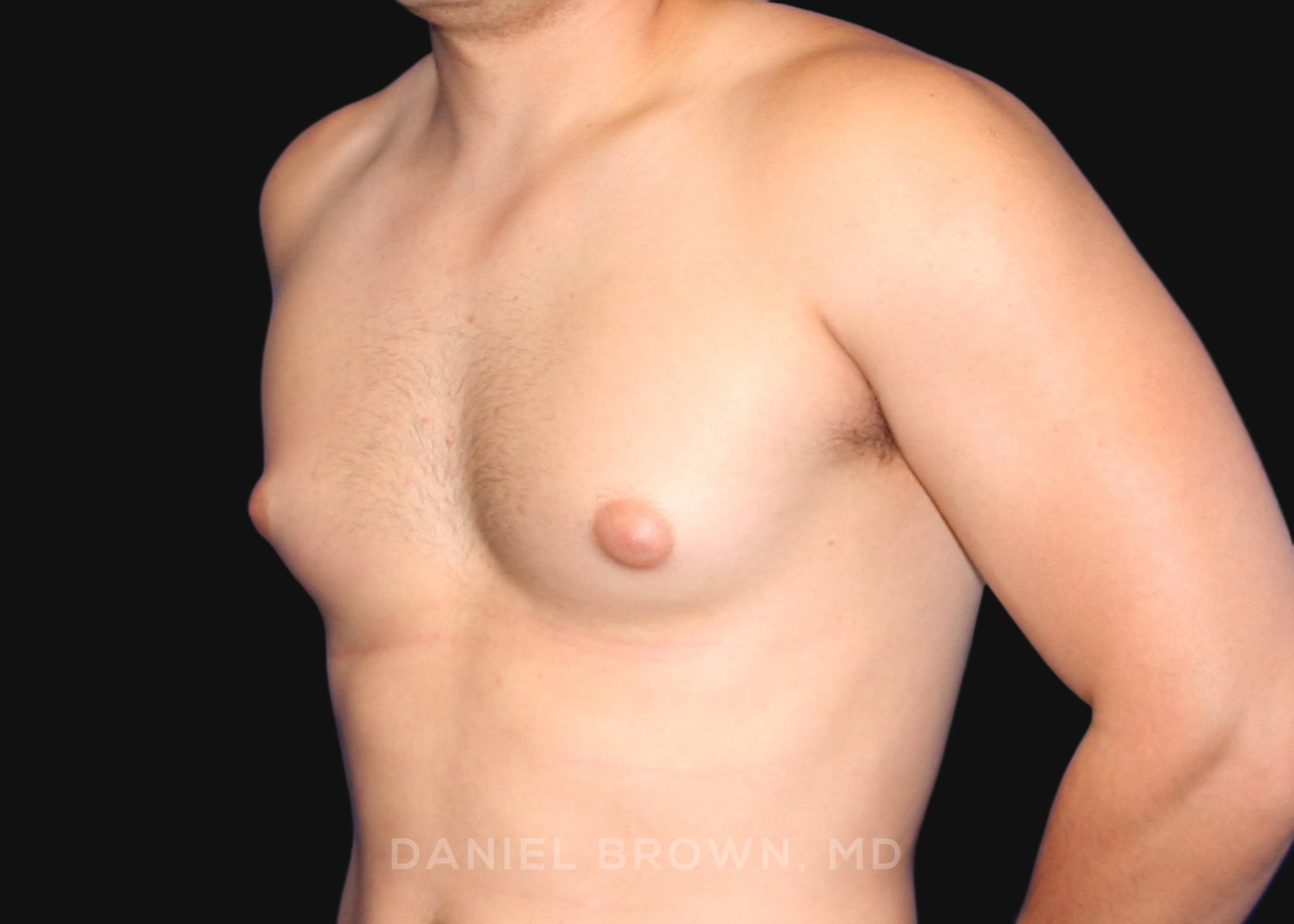 Male Breast Reduction Patient Photo - Case 2562 - before view-1