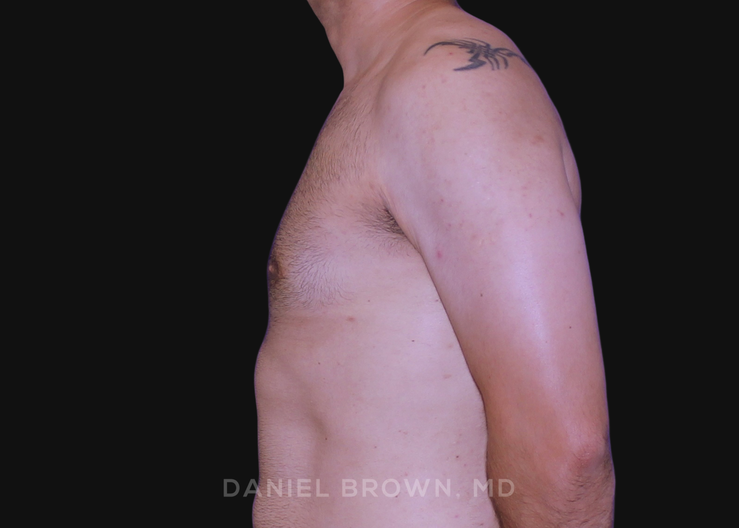 Male Breast Reduction Patient Photo - Case 2569 - after view