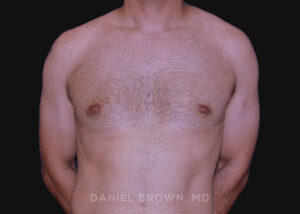 Male Breast Reduction - Case 2569 - After