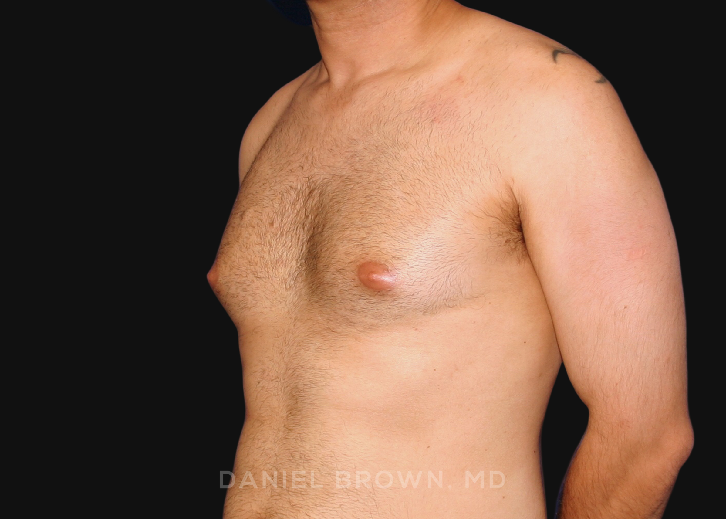 Male Breast Reduction Patient Photo - Case 2569 - before view-1