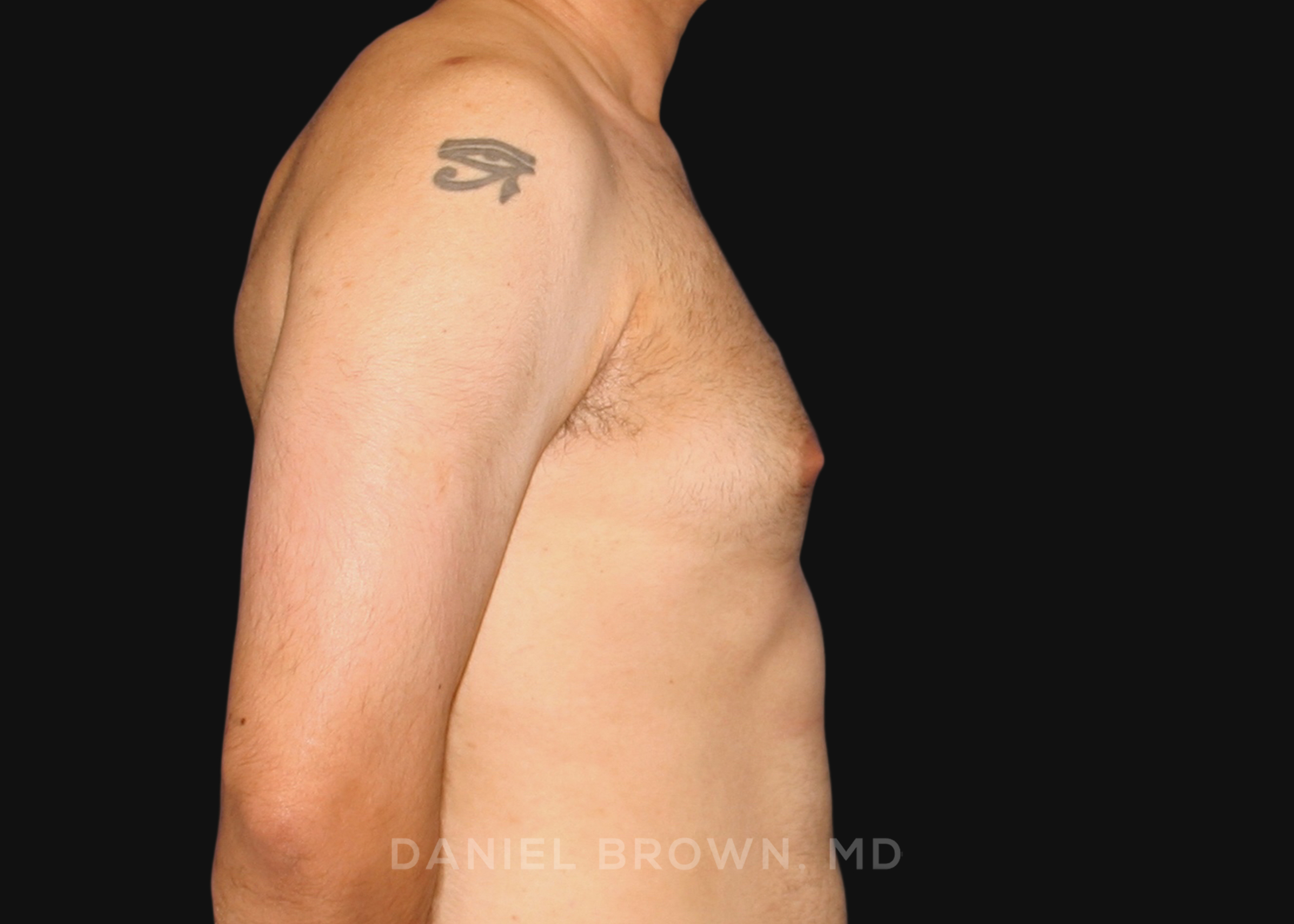 Male Breast Reduction Patient Photo - Case 2569 - before view-4