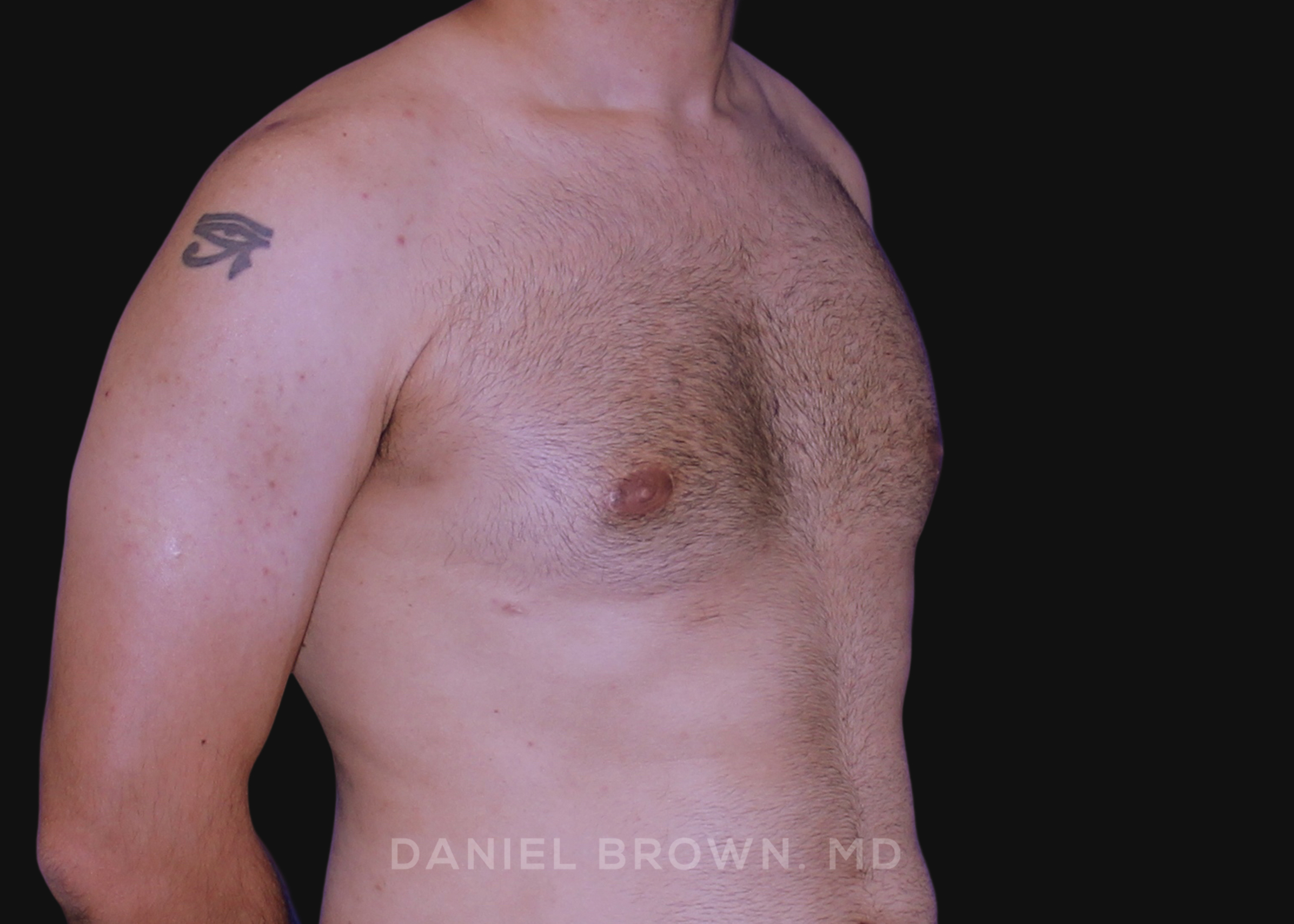 Male Breast Reduction Patient Photo - Case 2569 - after view-2