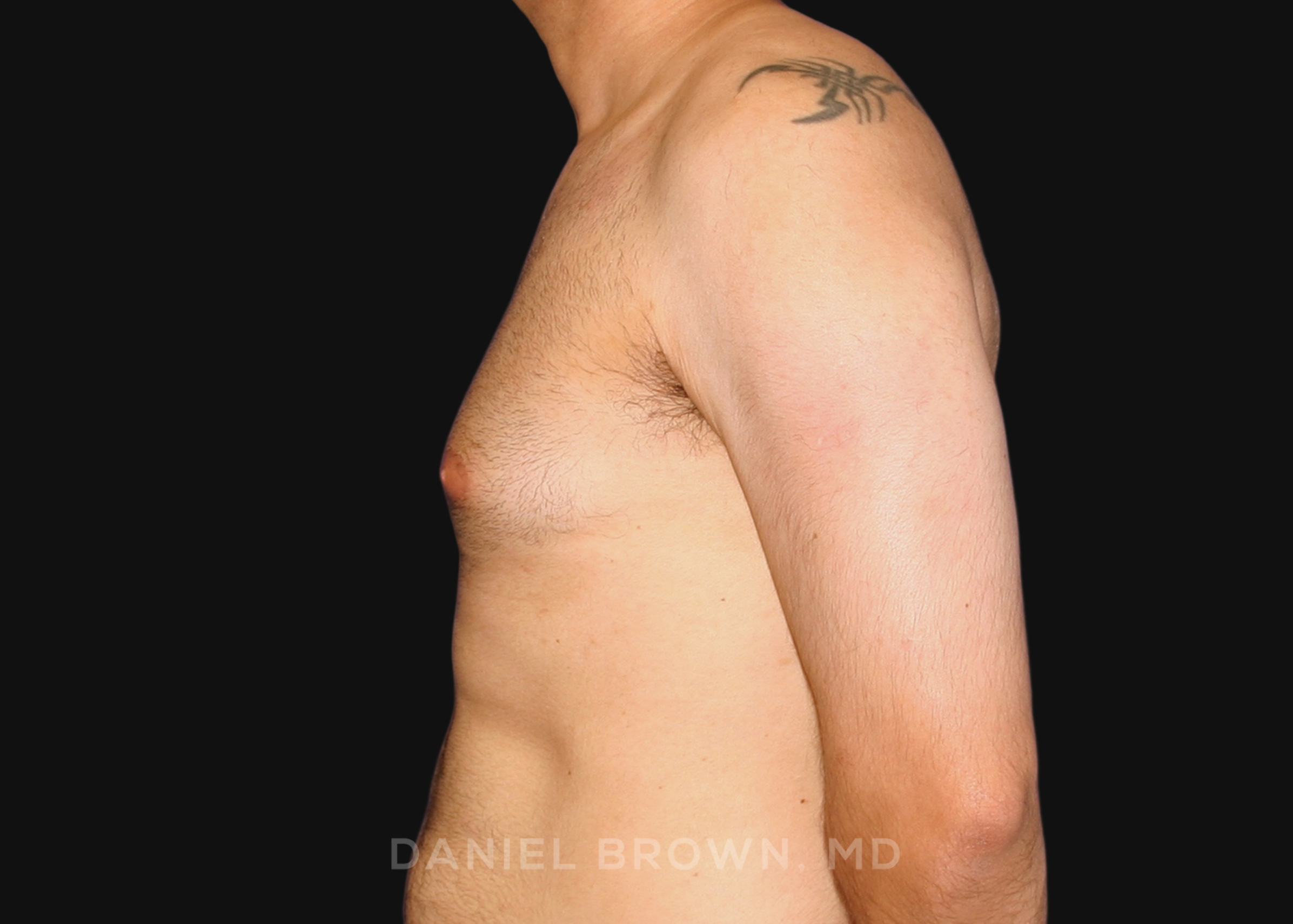 Male Breast Reduction Patient Photo - Case 2569 - before view-3