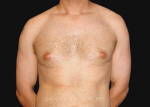 Male Breast Reduction - Case 2569 - Before