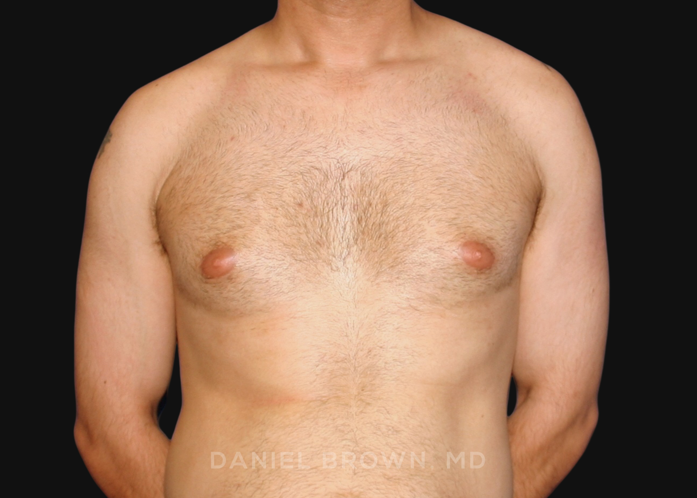 Male Breast Reduction Patient Photo - Case 2569 - before view-0