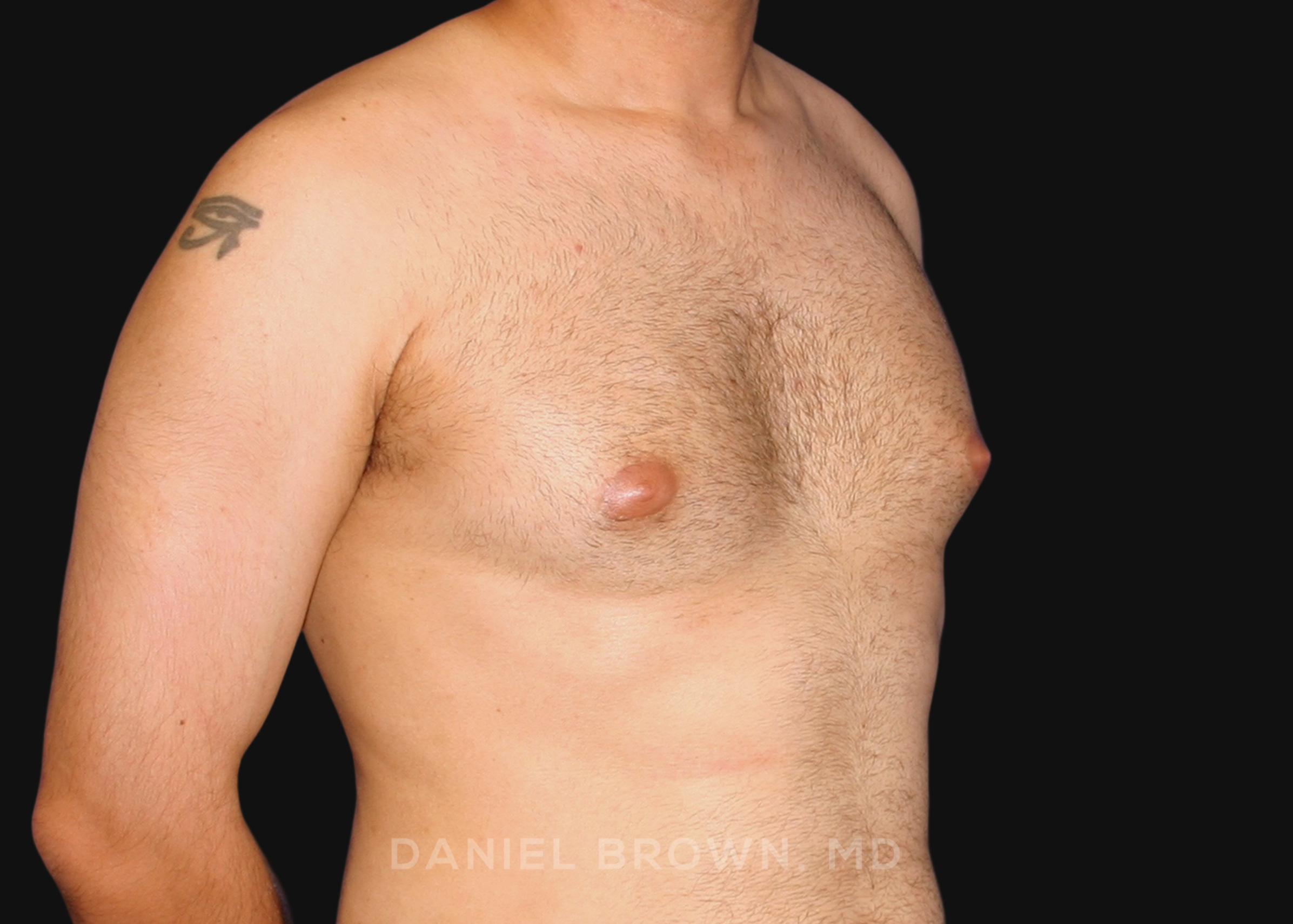Male Breast Reduction Patient Photo - Case 2569 - before view-2