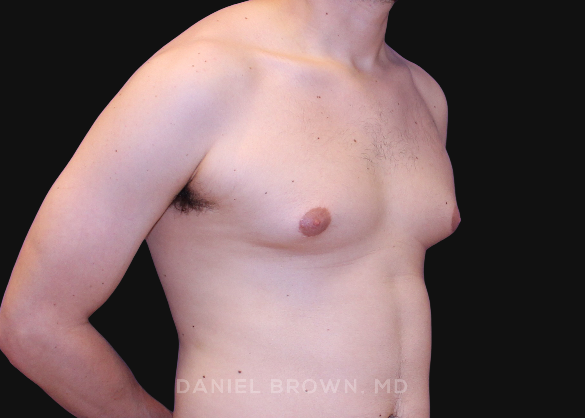 Male Breast Reduction Patient Photo - Case 2580 - before view-2