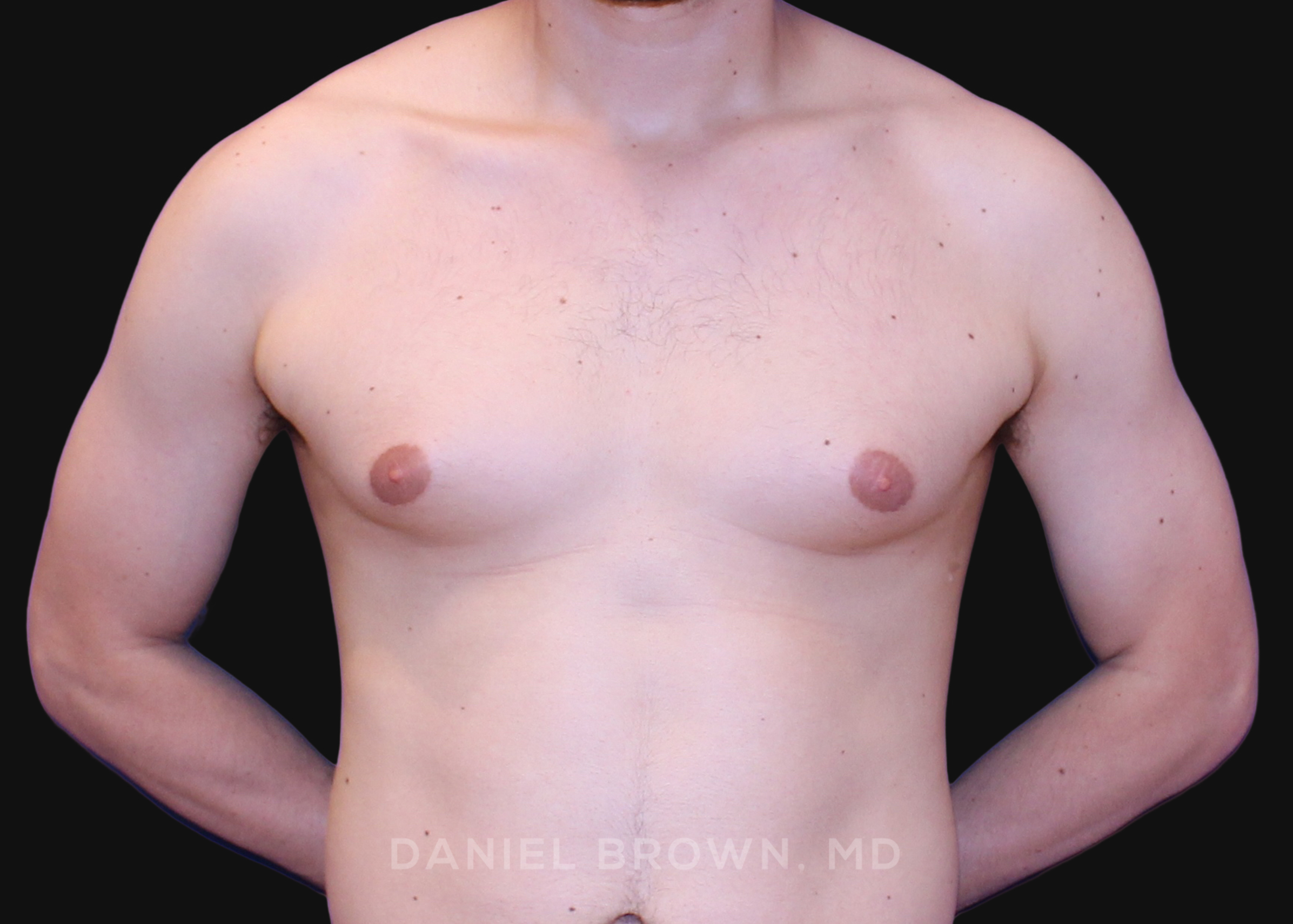 Male Breast Reduction Patient Photo - Case 2580 - before view-0