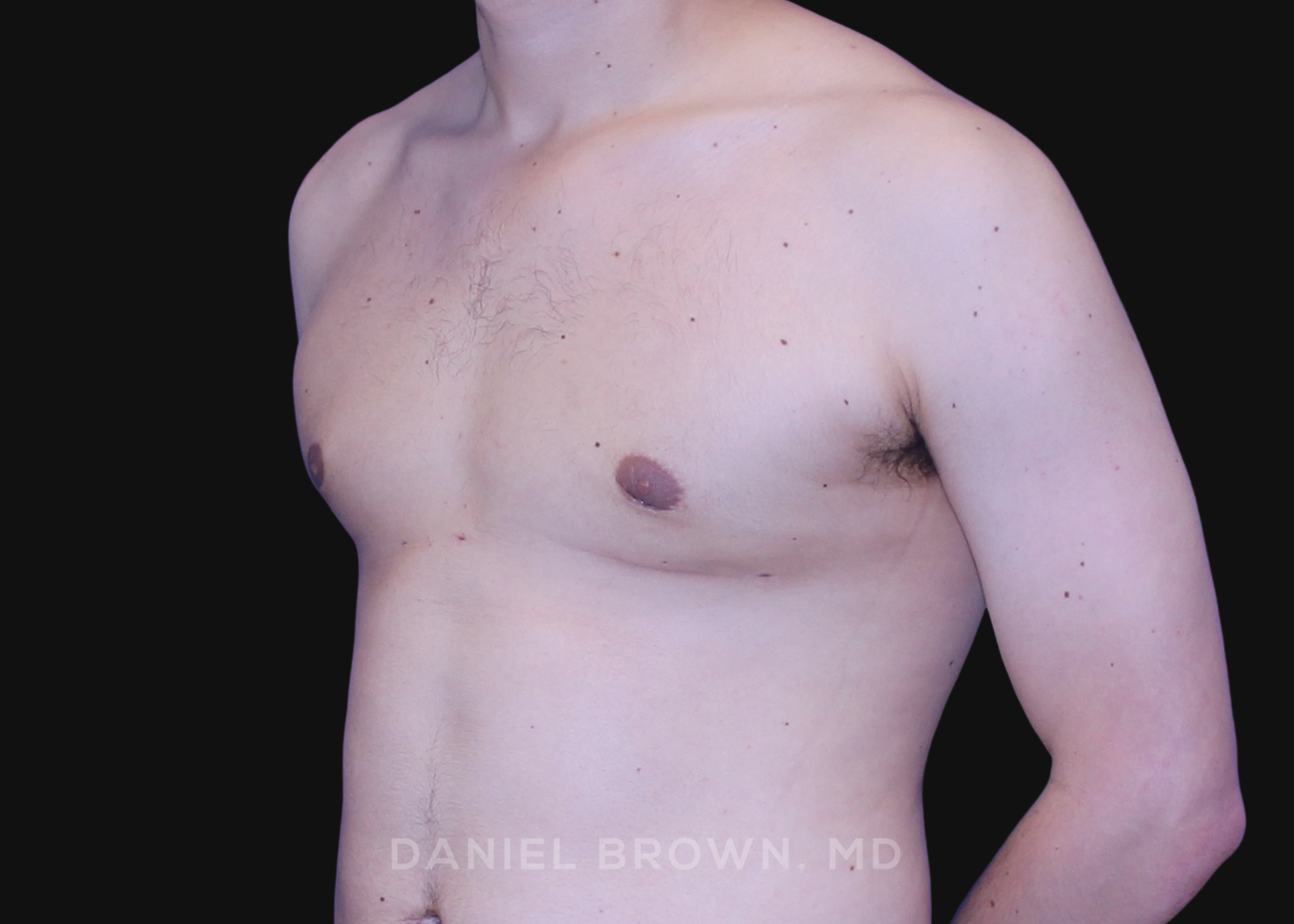 Male Breast Reduction Patient Photo - Case 2580 - after view