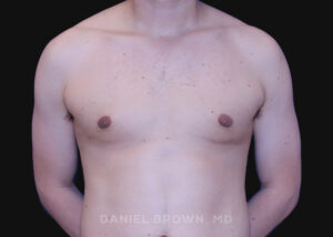 Male Breast Reduction - Case 2580 - After