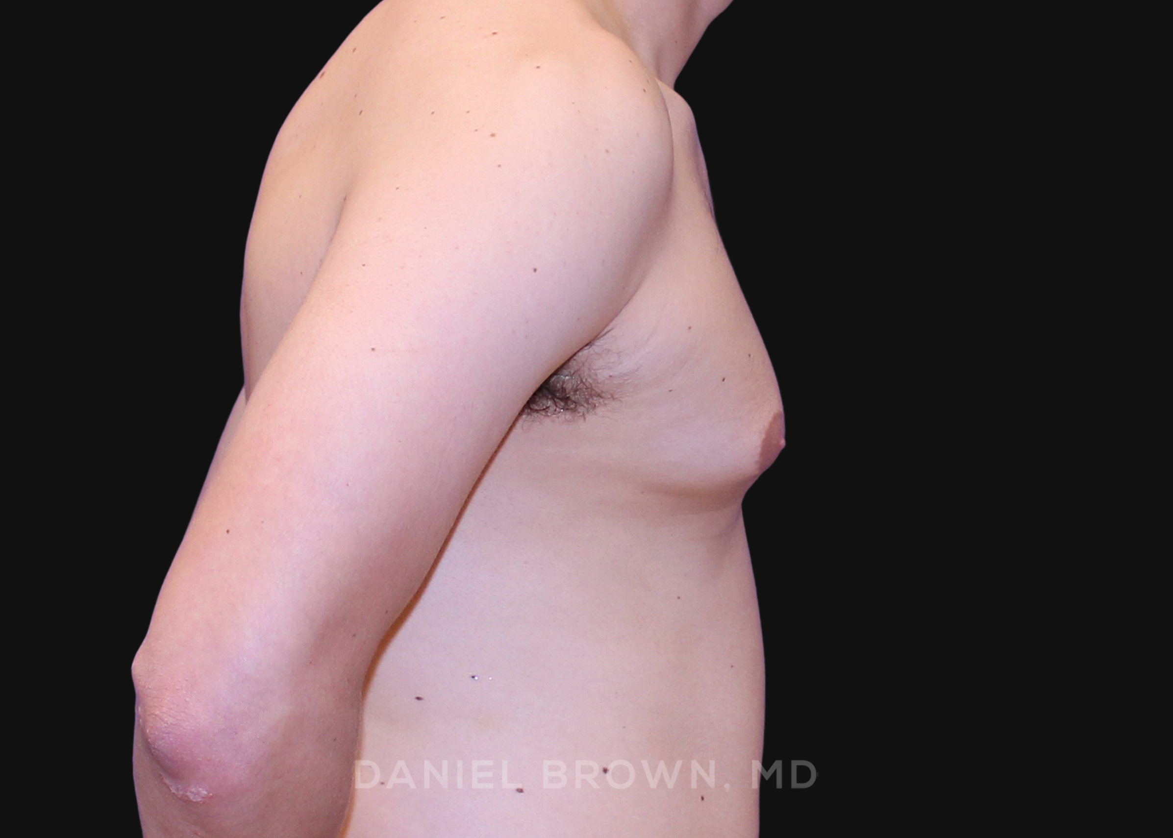 Male Breast Reduction Patient Photo - Case 2580 - before view-4