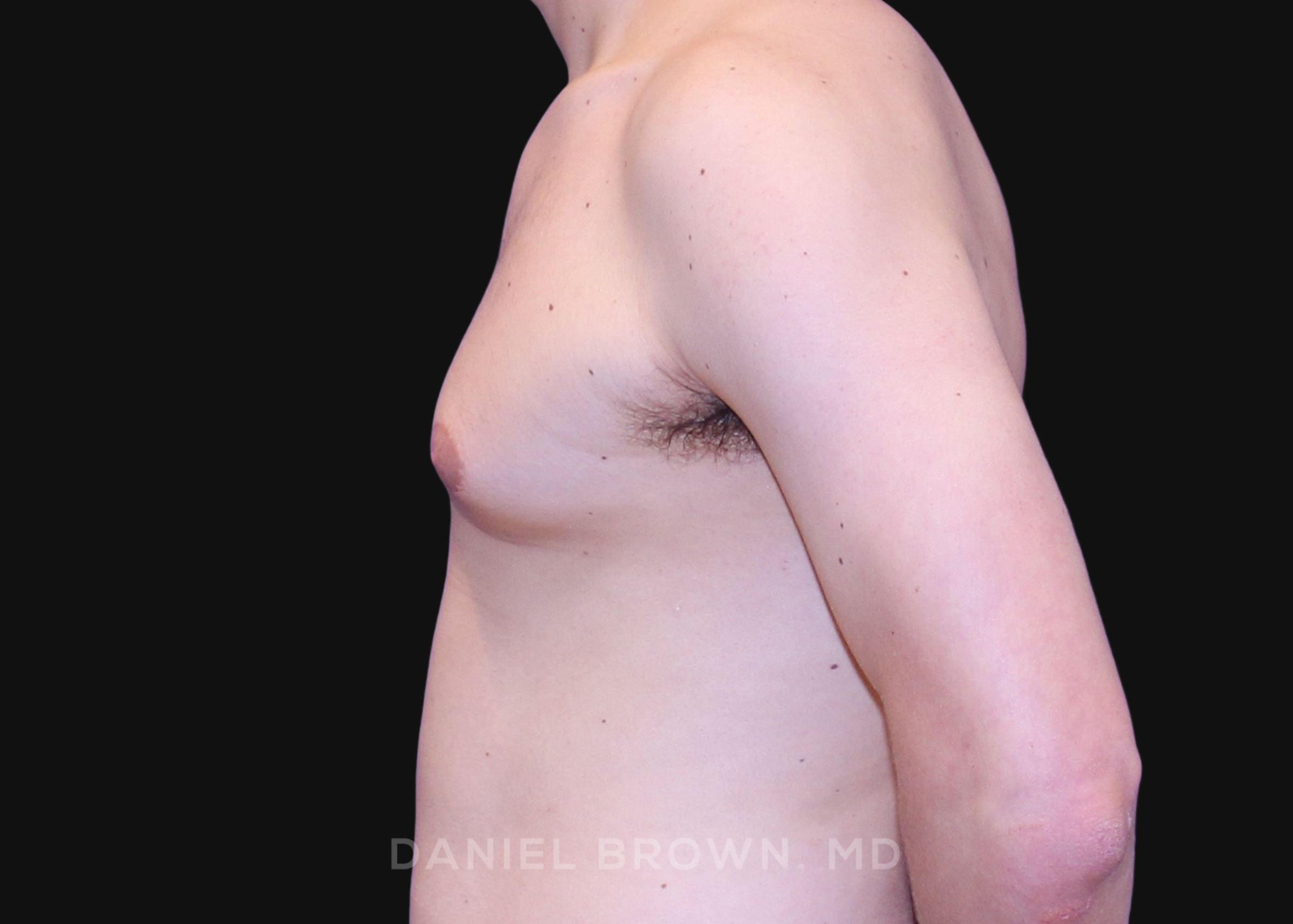 Male Breast Reduction Patient Photo - Case 2580 - before view-3